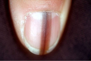 Como curar la psoriasis sobre las uñas